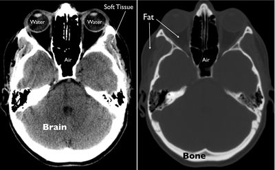 Exploring the brain CT.jpg